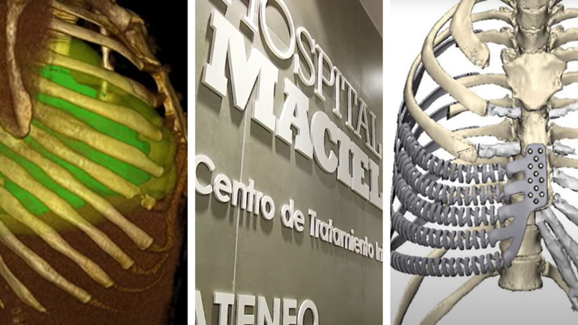 Hospital Maciel Pionero en Cirugía Torácica con Impresión 3D